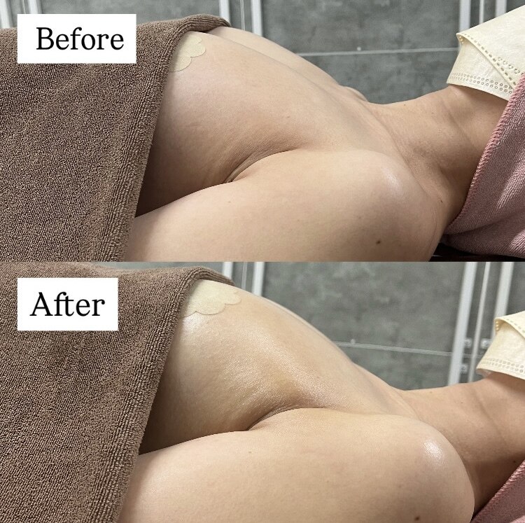 バストアップ症例